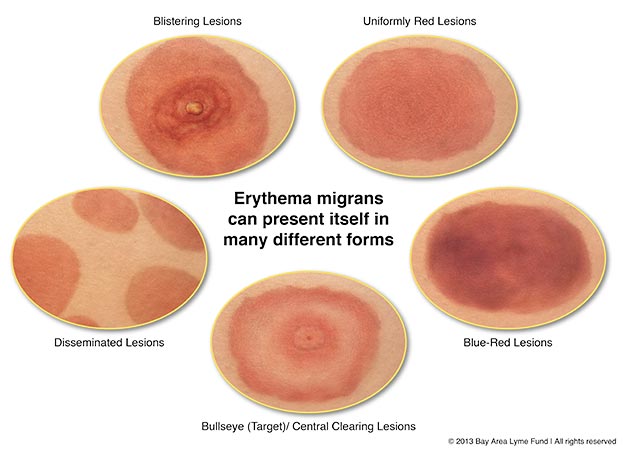 Lyme rash doesn't always look like a bulls eye